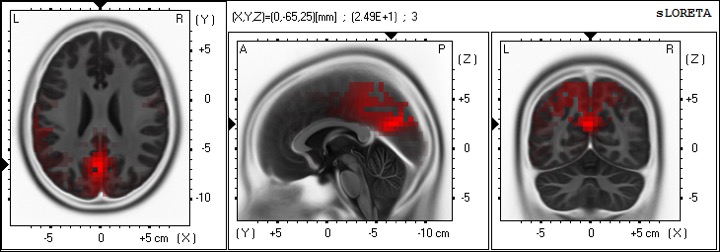 脚部へのマッサージ後、後帯状皮質が活性化している様子