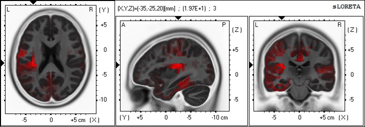 腕部へのマッサージ後、島皮質が活性化している様子